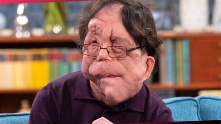 Adam Pearson Age: Unveiling the Journey and Legacy of a Remarkable Figure