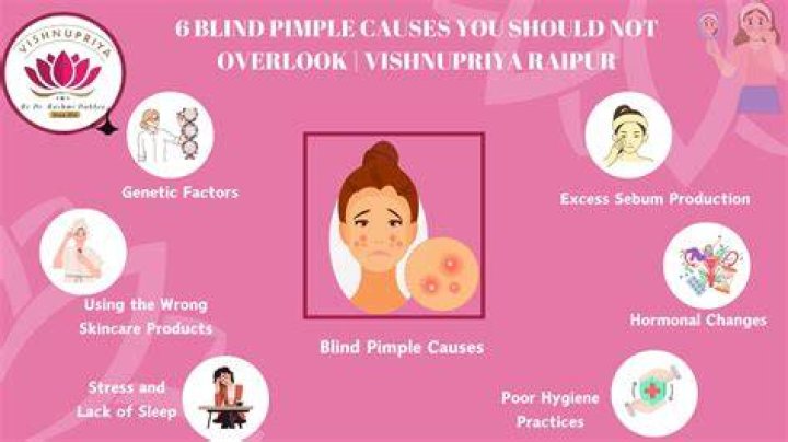 Comprehensive Guide to Blind Pimple Diagram: Understanding Causes, Treatments, and Prevention