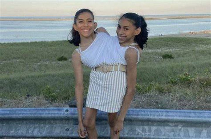 Conjoined Twins' Current Life: A Journey of Resilience, Love, and Hope