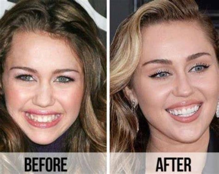 Dentures Before and After: Celebrity Transformations with Full Dentures