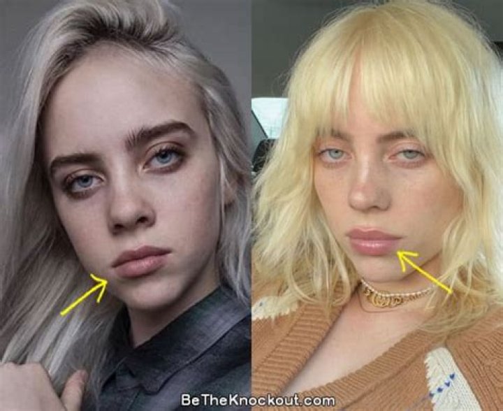 Did Billie Eilish Get a Breast Reduction? Exploring the Facts