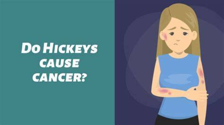 Do Hickeys Cause Cancer? Debunking the Myth and Understanding the Truth