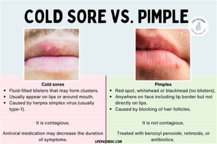 Does a Cold Sore Pop Like a Pimple? Everything You Need to Know