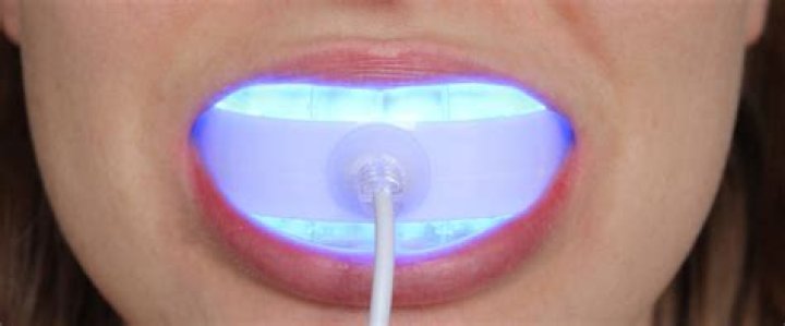 Does Blue Light Help Whiten Teeth: A Comprehensive Guide
