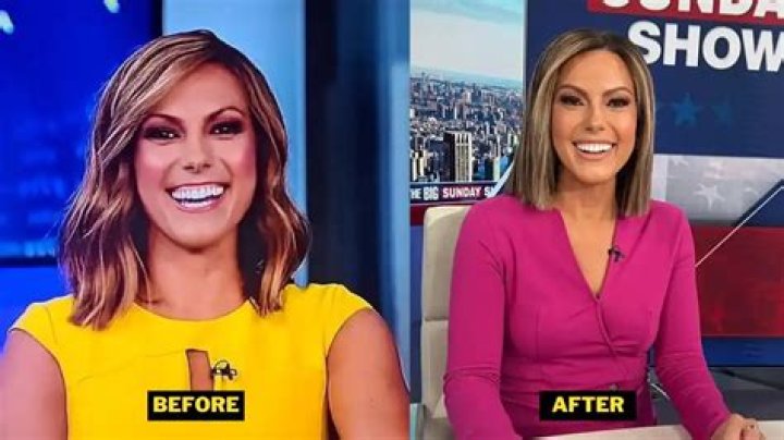 Fox News Anchor Plastic Surgery Before and After: A Comprehensive Exploration