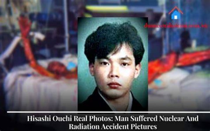 Hisashi Ouchi Real Photos: The Untold Story Behind the Tragic Event