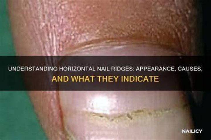 Horizontal Ridges on Your Nails: Causes, Treatments, and What They Indicate