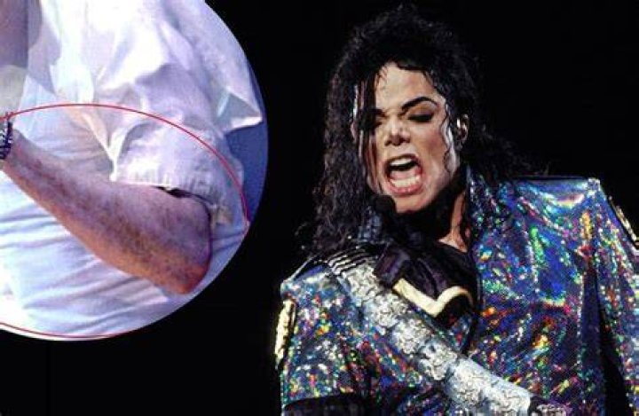 Michael Jackson with Vitiligo: A Comprehensive Exploration