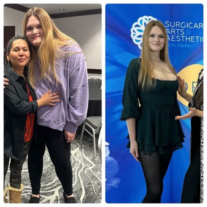 Ozempic Before and After: Transforming Lives Through Weight Loss and Diabetes Management
