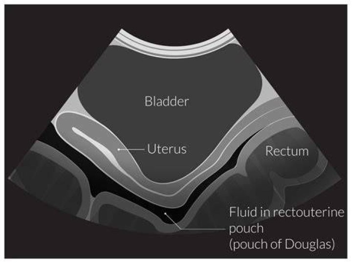 Pouch of Douglas on Ultrasound: A Comprehensive Guide
