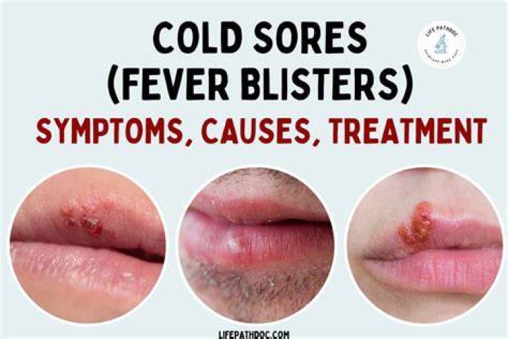 Should You Pop a Cold Sore Blister? Everything You Need to Know