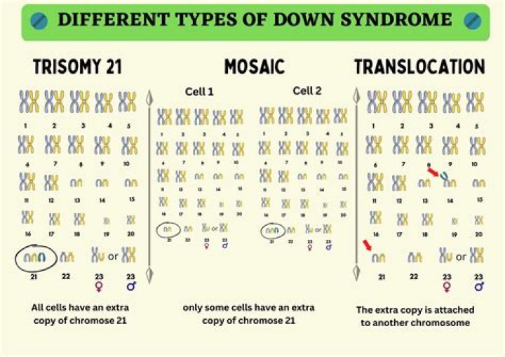 Understanding Trisomy 13 Mosaicism: Causes, Symptoms, Diagnosis, and Management