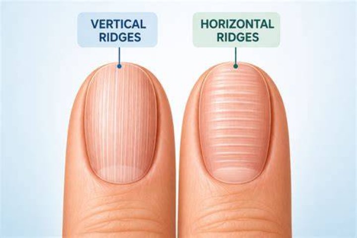 Understanding Vertical Ridged Nails and Thyroid: A Comprehensive Guide