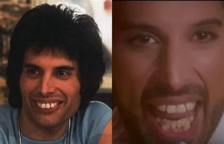 What Was Wrong with Freddie Mercury's Teeth: Unveiling the Truth Behind the Iconic Smile