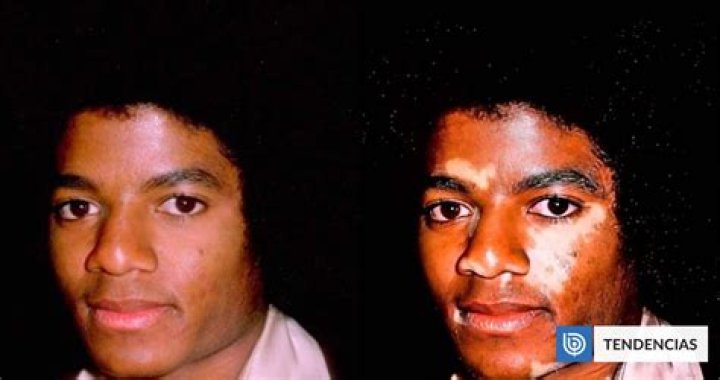 When Did Michael Jackson Get Vitiligo: A Comprehensive Guide
