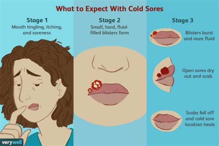 Will a Cold Sore Pop? Understanding the Myths and Realities